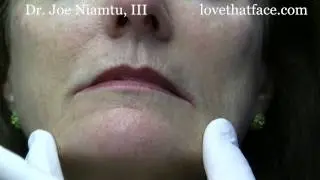 Botox Injection to DAO (corner of mouth) by Dr. Joe Niamtu, III