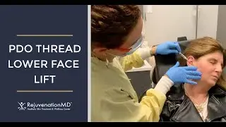 Lower Facelift with PDO Threads