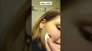 Huge pimple sqiorts everywhere