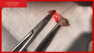 Skin tightening & fat test | Endolift® - Antiaging laser lifting [Eufoton®]