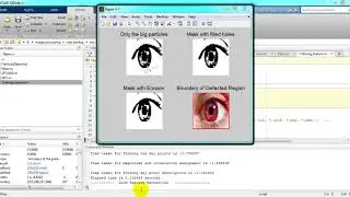 Iris Segmentation Method of Pterygium Anterior Segment Photographed Image