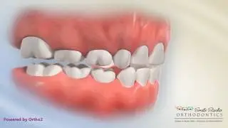 Anterior Crossbite Functional Shift