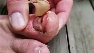Horrendous toenail accident and full peel off.
