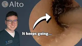 NEVER ENDING Ear Wax!! | Alto Microsuction