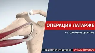 Операция Латарже на плечевом суставе