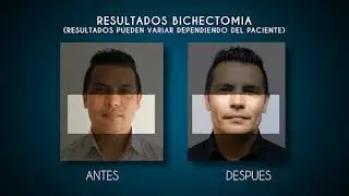 Bichectomia Cristian y sus resultados