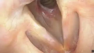 Subglottic Stenosis: before and after surgery