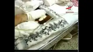 Chinese girl lost her both legs in a car accident