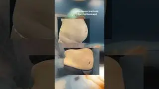 Абдоминопластика с ушиванием диастаза