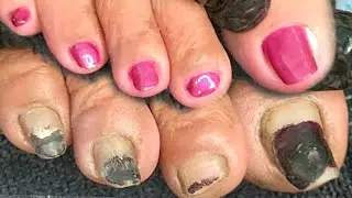 PART1 DIRTY LONG  TOENAILS TRANSFORMATION.