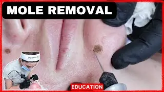 Mole Removal with Plasma Pen BEFORE AND AFTER (2024)