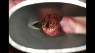 Ларингомаляция II типа и супраглоттопластика / Type II Laryngomalacia and Supraglottoplasty