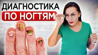 Посмотрите на свои НОГТИ, возможно вы чем-то БОЛЬНЫ! / О чем может сказать состояние наших ногтей?