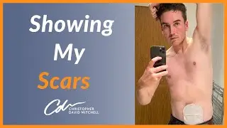 I Show My Scars from IBD Surgery (Never Seen Before!)