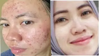 My Acne Story//Stop pakai Goddesskin acne Klinik kecantikan Athena