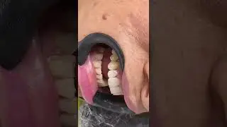 Como fazer Facetas em resina à mão livre - caso ao vivo