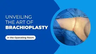 Unveiling the Art of Brachioplasty