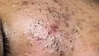 POPPING BLACKHEADS ON FACE [NEWEST BLACKHEADS VIDEOS 2021]