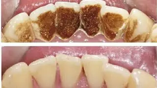 Тишдаги тош кумларни тозалаш,фойдали маслахат