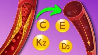 Unlock The SECRET To Reversing CORONARY ARTERY DISEASE In Just WEEKS!