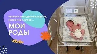 МОИ РОДЫ 2022: экстренное кесарево сечение, двойное обвитие пуповиной, истинный узел пуповины.