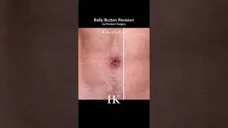 Outie to innie (umbilicoplasty) Belly Button Revision Surgery | Dr. Khorasani