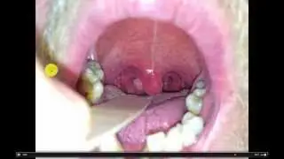 Follow up: Uvular Mass Video