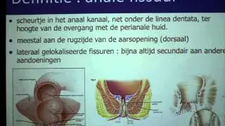 Anale fissuur - proctologie - Dr. Tom Feryn