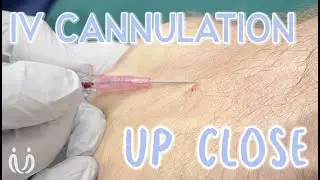 Up Close: Peripheral IV Cannulation & Local Anaesthetic