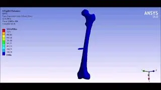 Ansys Explicit Dynamics Analysis Femur