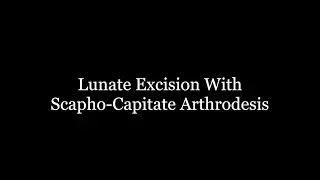 Lunate Excision with Scaphocapitate Arthrodesis Surgery