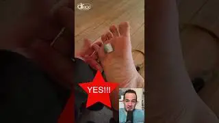 DOCTOR REACTS - PLANTAR WARTS & DUCT TAPE!😱 