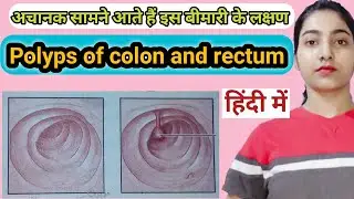 polyps of colon and rectum in hindi |Causes and risk factors|Symptoms|Treatment|Msn|
