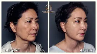 SMAS lifting in Korea - Korean woman review 