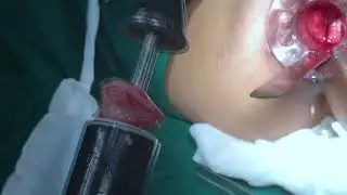 TRRPCS – A New Promising Technique in Treatment of Rectal Prolapse