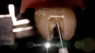 Flowable composite for Class II (Surefil SDR Flow +)