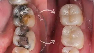Ceramic ONLAY & OVERLAY cementation: Step-by-Step