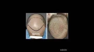 HAIR TRANSPLANT USING FUE TECHNIQUE WITH 3800 GRAFTS! 👌👌