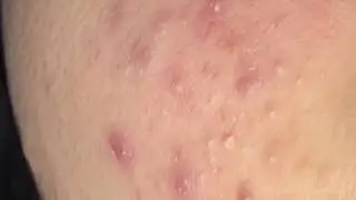 Tokyo Acne Treatment Blackhead Extractions Popping #50