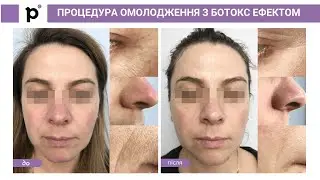 Інтенсивна процедура омолодження для боротьби з мімічними зморшками
