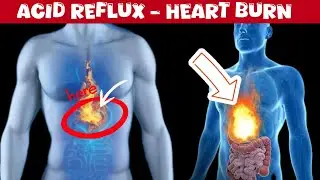 Heartburn Acid Reflux And GERD | How To Get Rid of Acid Reflux | Symptoms | Causes | Treatment