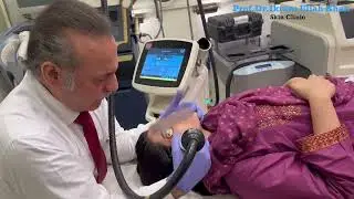 Bye-Bye Acne Pits! Erbium Glass Laser Filled In My Scars  #scarstreatment #lasertherapy