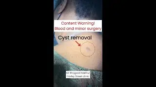 Cyst removal
