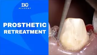 Prosthetic retreatment
