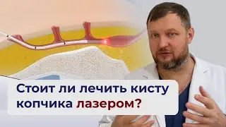 Стоит ли лечить кисту копчика лазером? | ПРОКТОЛОГ ЕФИМ ХАРАБЕТ