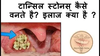 Tonsil Stones - Tonsilloliths Causes and Treatment - IN HINDI