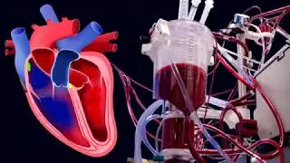 Motion Graphics - 2D Animation - After Effects Sample (Topic Vavular Heart Disease)