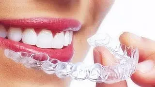 Новейшая ортодонтия. Invisalign или Брекеты?