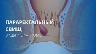 Параректальный свищ. Виды и симптомы.