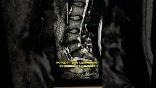 ЛАЙФХАК. Самый быстрый способ заработать себе грыжу. Читайте в комментарий признаки грыжи п.о.п